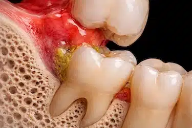 Acumulación de bacterias y restos de comida en encía junto a muela del juicio