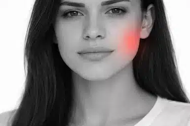 Hinchazón en la cara por infección en muela del juicio con pericoronaritis