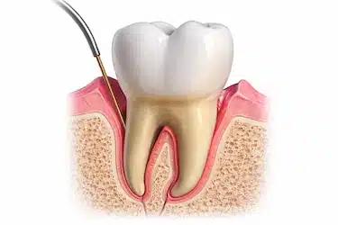 Limpieza y desinfección de encía en muela del juicio con pericoronaritis