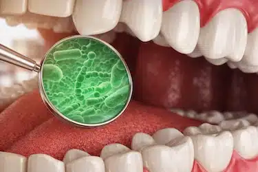 Mala higiene oral con bacterias que aumentan el riesgo de infección y alveolitis