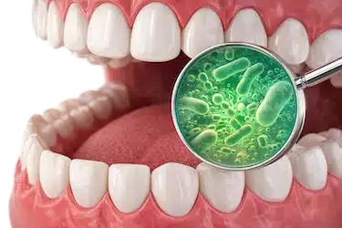 Bacterias en dientes por mala higiene que favorecen pericoronaritis
