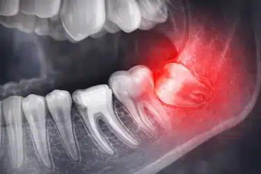 Muela del juicio impactada en radiografía por falta de espacio en la mandíbula