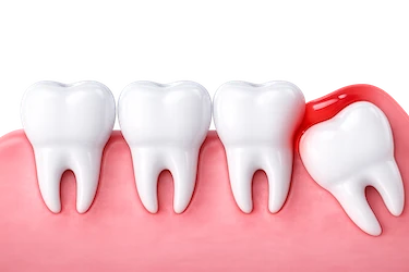 Pericoronaritis aguda con encía inflamada en muela del juicio