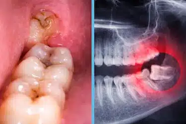 Molestia leve continua en muela del juicio parcialmente erupcionada