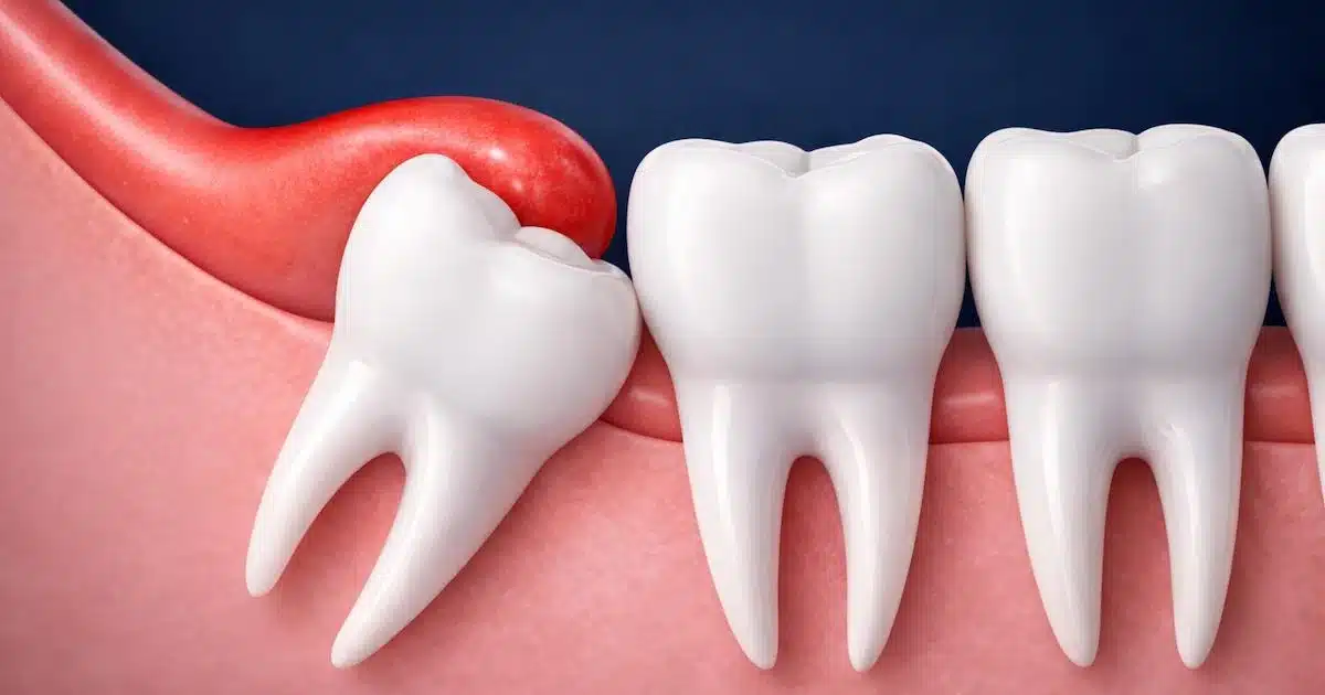 Pericoronaritis en muela del juicio con encía inflamada