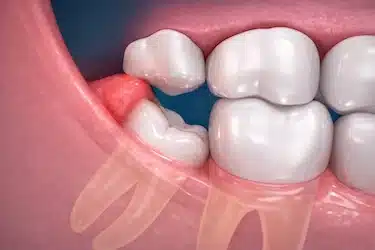 Contacto al morder irrita la encía sobre muela del juicio parcialmente erupcionada