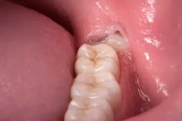 Encía inflamada que reaparece en muela del juicio parcialmente erupcionada