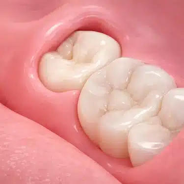 Muela del juicio parcialmente erupcionada con encía inflamada