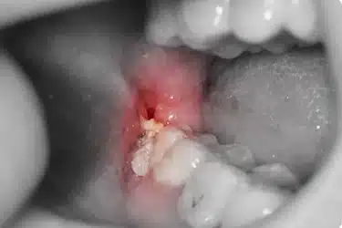 Salida de pus en encía por pericoronaritis avanzada en muela del juicio