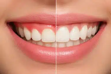 Resultado antes y después de una gingivectomía para reducir encía inflamada