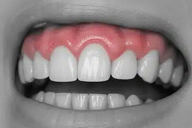 Encías hinchadas y con aumento de volumen por gingivitis
