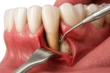 Cirugía periodontal para eliminar infección y bolsas periodontales profundas