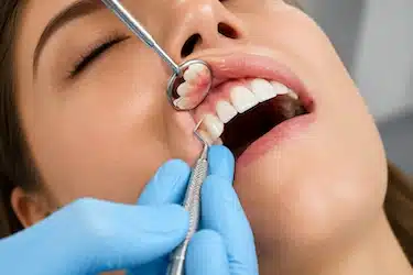Curetaje dental para tratar inflamación y enfermedad periodontal