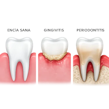 Comparación entre encía sana gingivitis y periodontitis avanzada