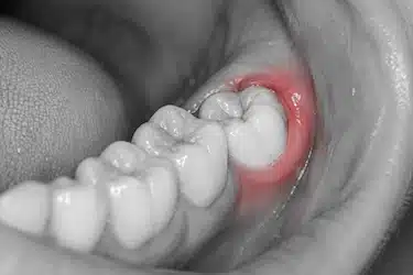 Inflamación de encías alrededor de una muela por gingivitis