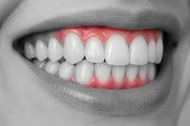 Encías inflamadas y enrojecidas causadas por gingivitis