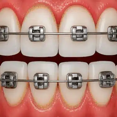 Encías inflamadas por gingivitis durante tratamiento de ortodoncia
