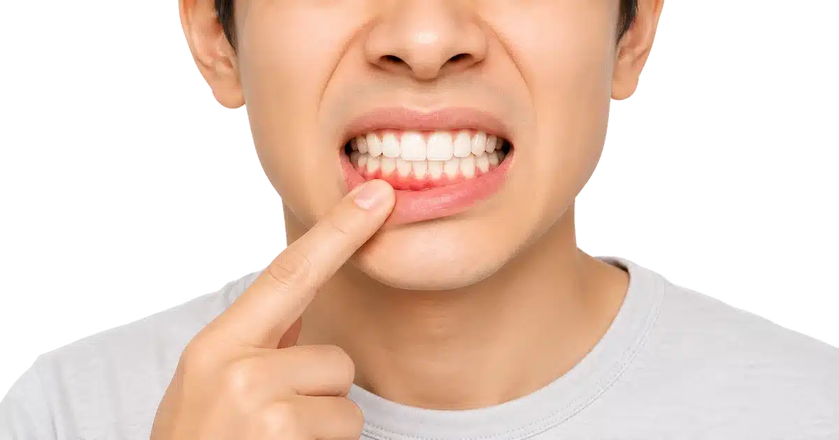 Encías inflamadas y sangrado de encías por gingivitis