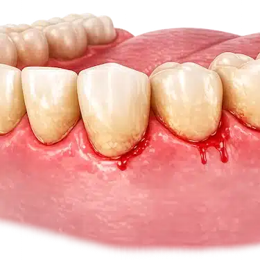 Sangrado de encías e inflamación por gingivitis ulceronecrotizante