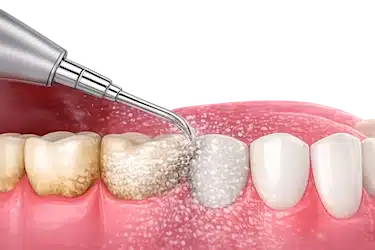 Limpieza dental profesional para eliminar sarro y tratar la gingivitis