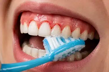 Sangrado de encías por mala higiene oral durante el cepillado