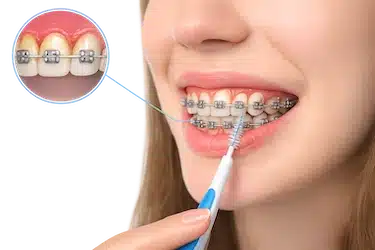 Brackets con inflamación de encías por dificultad de higiene dental