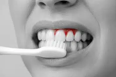 Encías sangrantes e inflamadas durante el cepillado dental