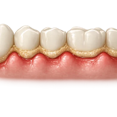 Sarro dental acumulado con encías inflamadas por gingivitis