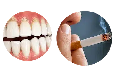 Tabaco y daño en las encías relacionado con gingivitis y periodontitis