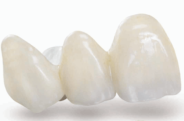 Dental Elizondo - Corona de porcela. Corona metal blanco