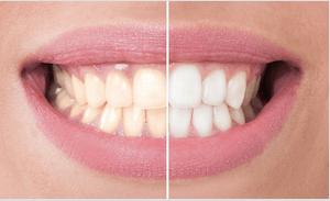 antes y despues dientes blancos y amarillos