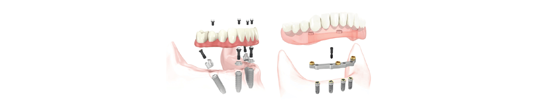  Carga inmediata - Clínica dental Dr. Ferrer | Madrid