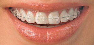 Brackets estéticos Ortodoncia dental y brackets efectivos