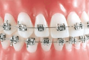 dientes torcidos brackets