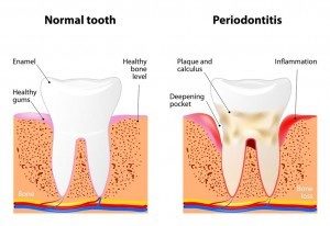 periodontitis