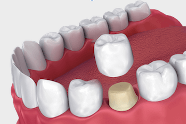 clases coronas dentales