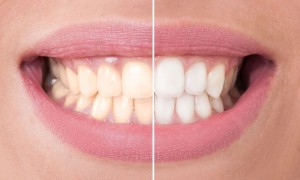 blanqueamiento dental tipos Blanqueamiento dental antes y despues
