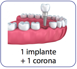 Implantes dentales Madrid