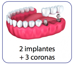 implantes dentales multiples