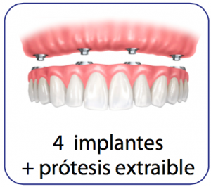 implantes dentales sobredentadura 