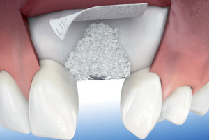 regeneracion hueso implantes dentarios