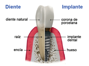 Implante dentario y corona