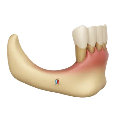 Ilustraci&oacute;n 3D de falta de hueso maxilar con p&eacute;rdida &oacute;sea y dificultad para implantes
