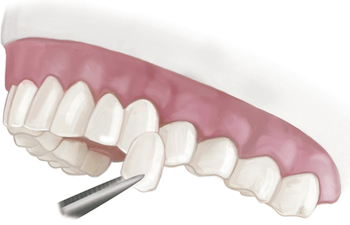 Colocacion carillas dentales