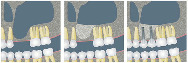 sinus lift elevacion de seno