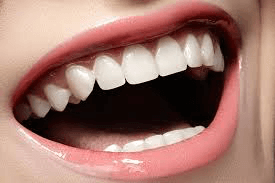 Carillas dentales de porcelana | dental Dr. Ferrer