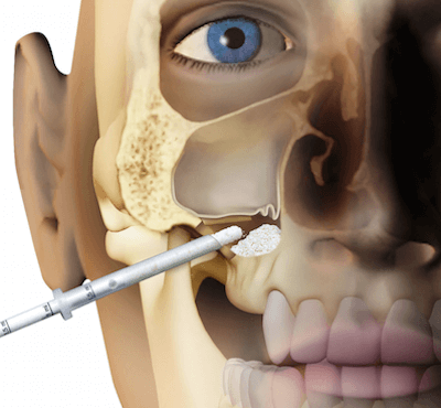  Elevación de seno maxilar y regeneración de hueso - Clínica dental Dr. Ferrer | Madrid