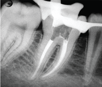 radiografia endodoncia
