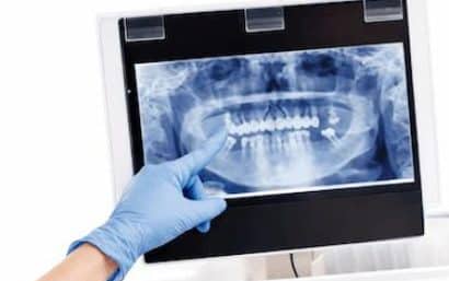 Radiografía dental panorámica para diagnóstico óseo y planificación de tratamientos dentales