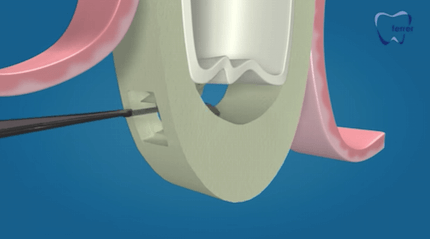 elevación de seno maxilar para implantes dentales